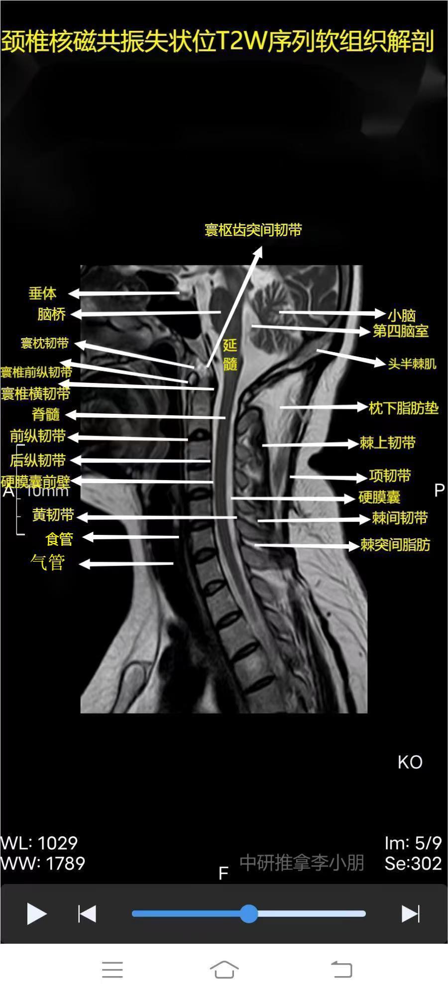 颈椎磁共振图片详解图片