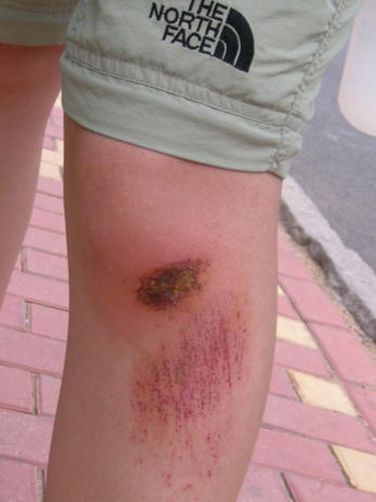 注意了有皮肤破损最好延期进行人工关节置换手术