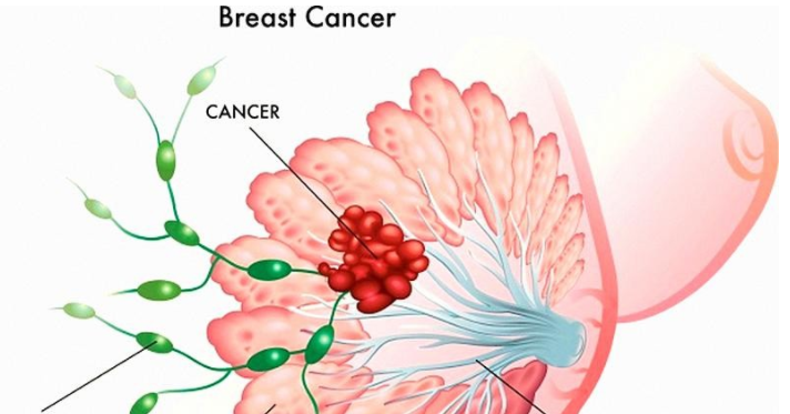 乳腺增生_症狀表現_檢查 - 好大夫在線