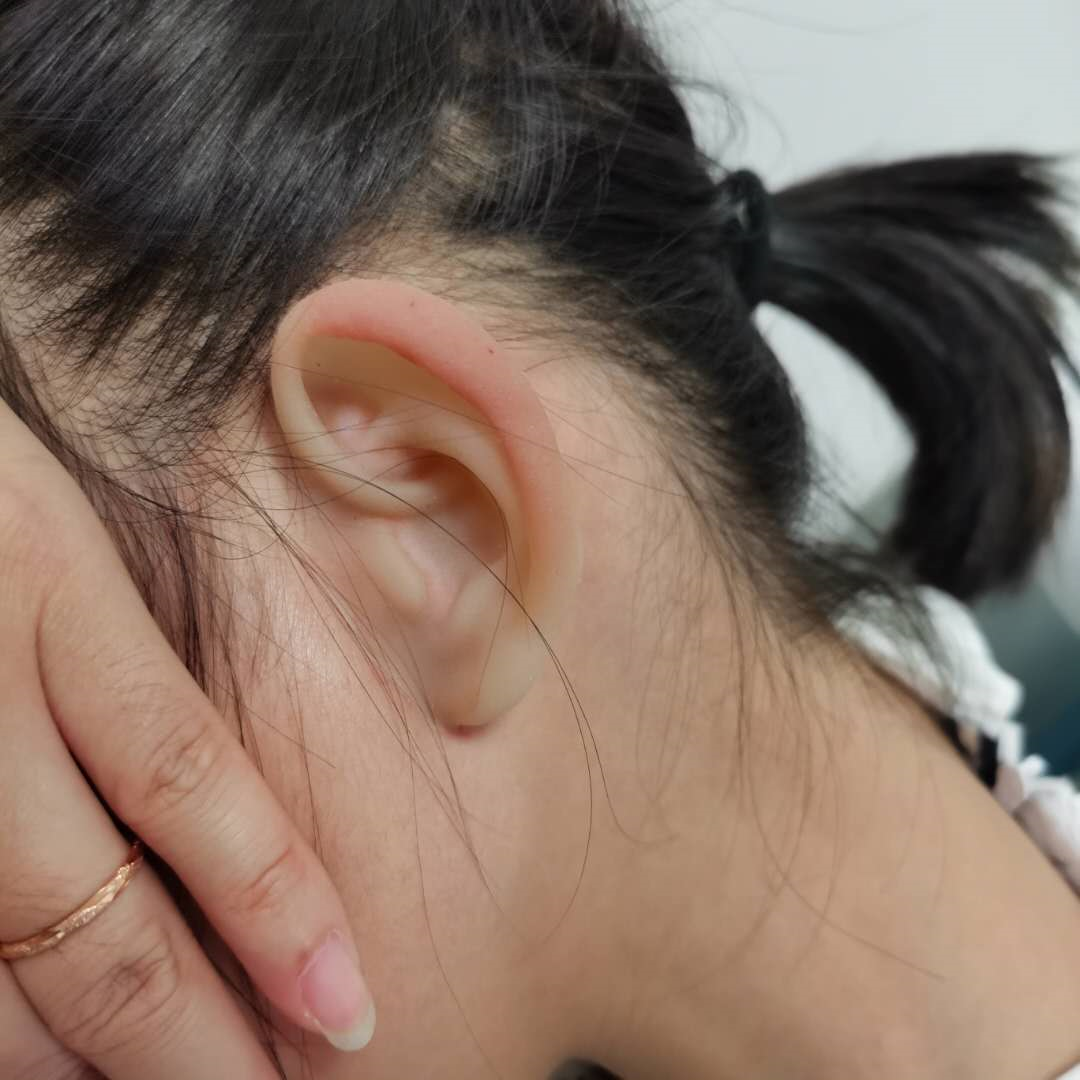 当我戴上5d义耳后得到了答案_耳再造_治疗方式_治疗介绍 - 好大夫