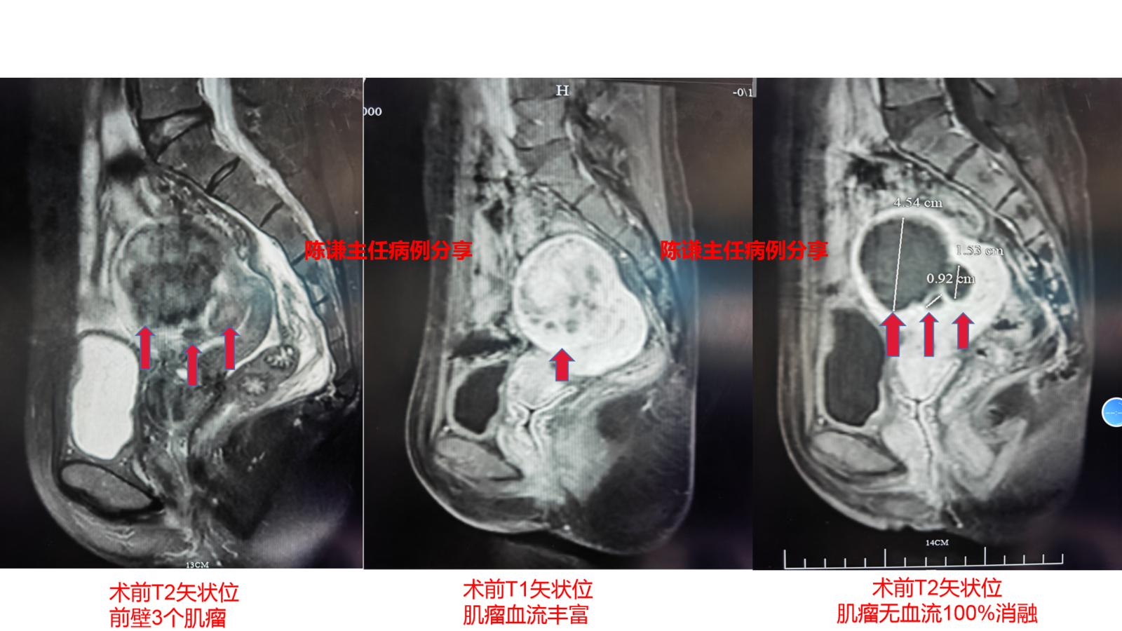 多發性子宮肌瘤海扶刀治療病例