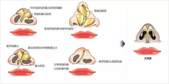 因此唇裂鼻畸形的修复手术方案比较多变,术式从简单的鼻翼软骨悬吊至