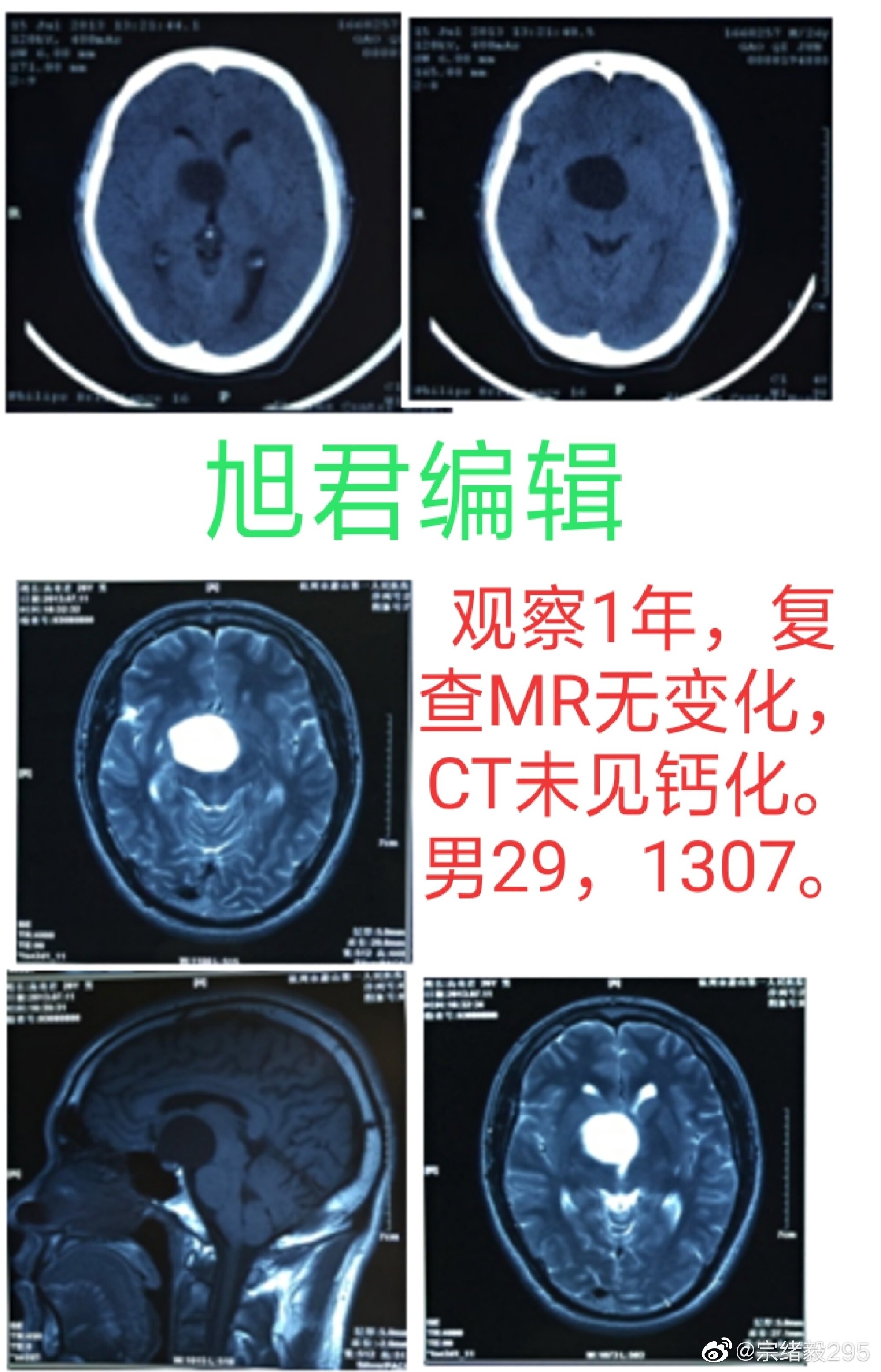 鞍上池囊肿的诊治(三) - 好大夫在线