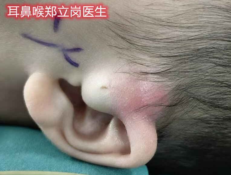 宝宝耳前瘘管红肿图片