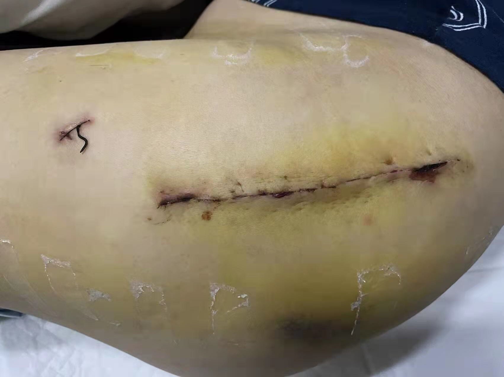 典型股骨头坏死髓心减压术后骨折病例 2010年美国阿拉巴马大学:股骨头