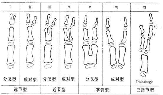 拇指多指的常见分型和治疗_多指畸形_多指畸形介绍 - 好大夫在线