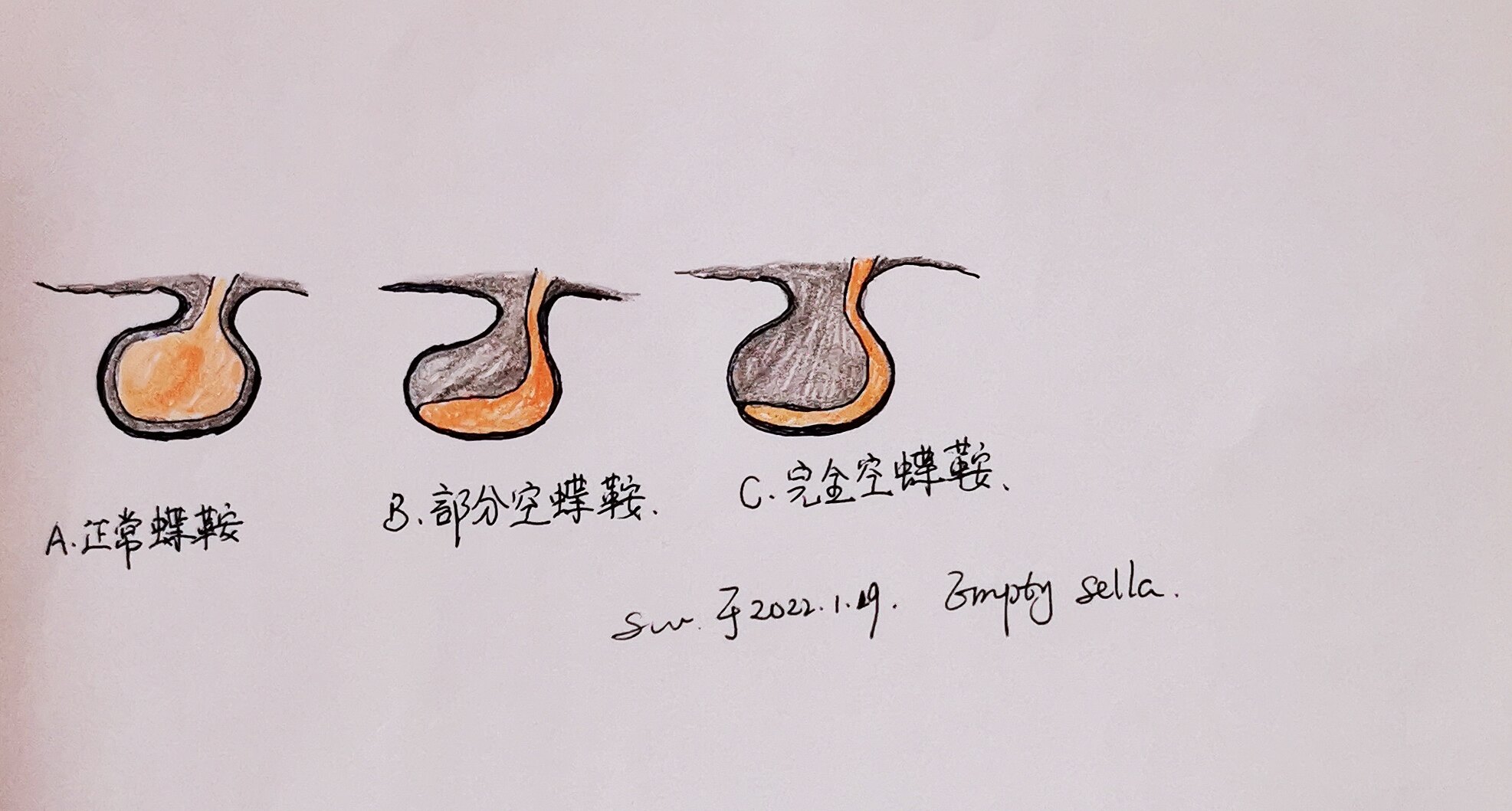 什么是空蝶鞍或空泡蝶鞍? ---手绘示意图,读完明明白白 - 好大夫在线