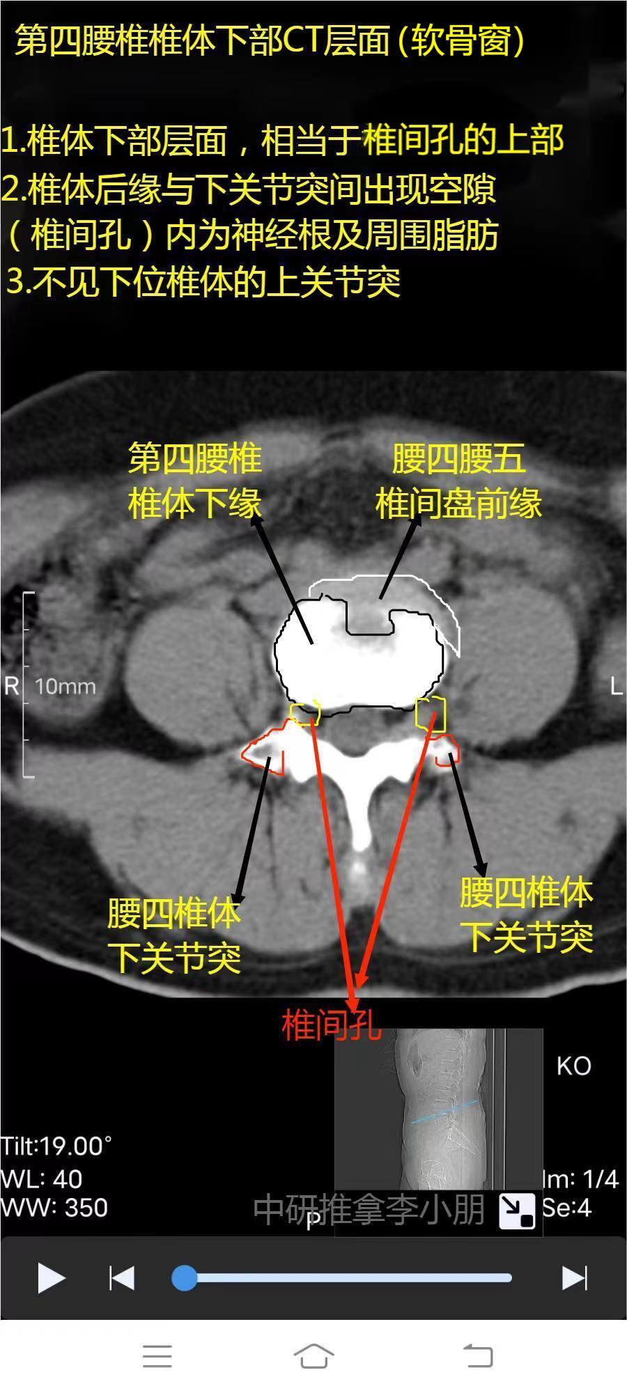 腰椎ct怎么看图解 片子图片