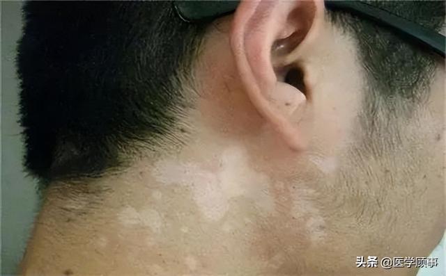 汗斑| 身上这些白色汗斑,简单洗洗就能除掉?13 - 好大夫在线