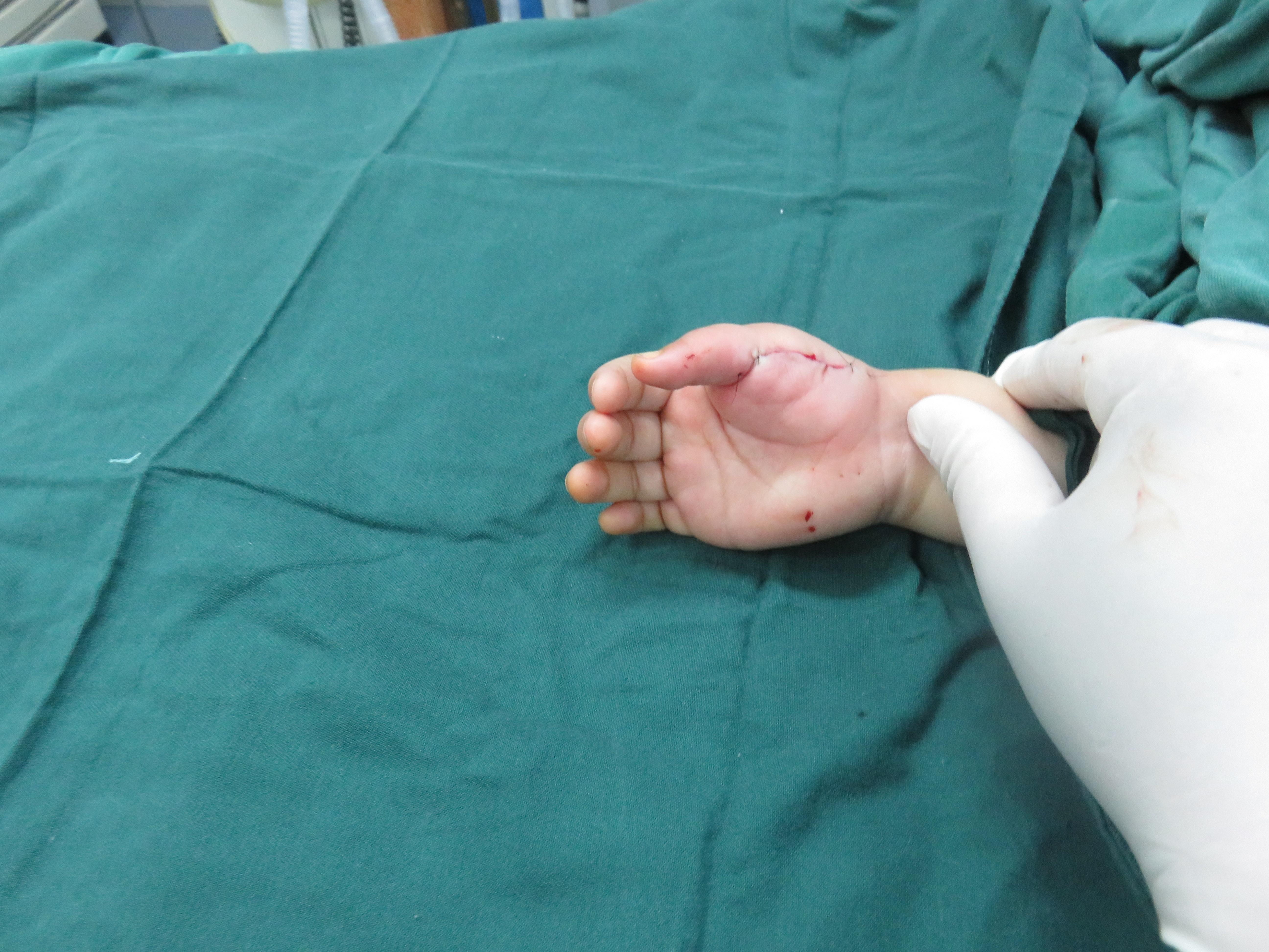 8203右手多指畸形畸形术前术后对比