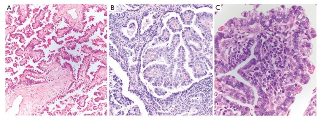 早期肺腺癌术后,病理报告浸润性腺癌,乳头型为主,需要基因检测吗?