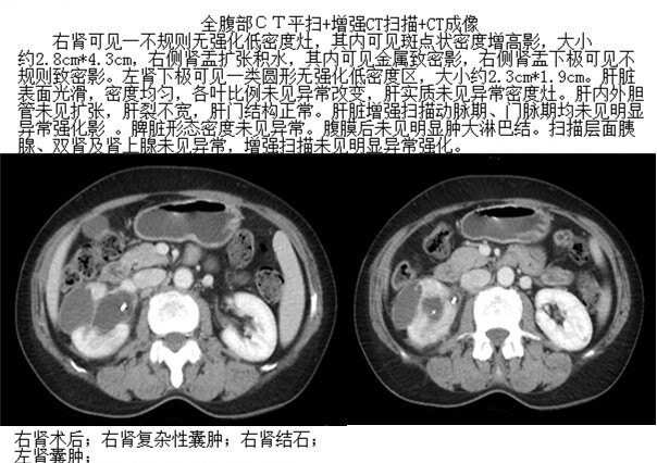 复杂性肾囊肿伴分隔钙化