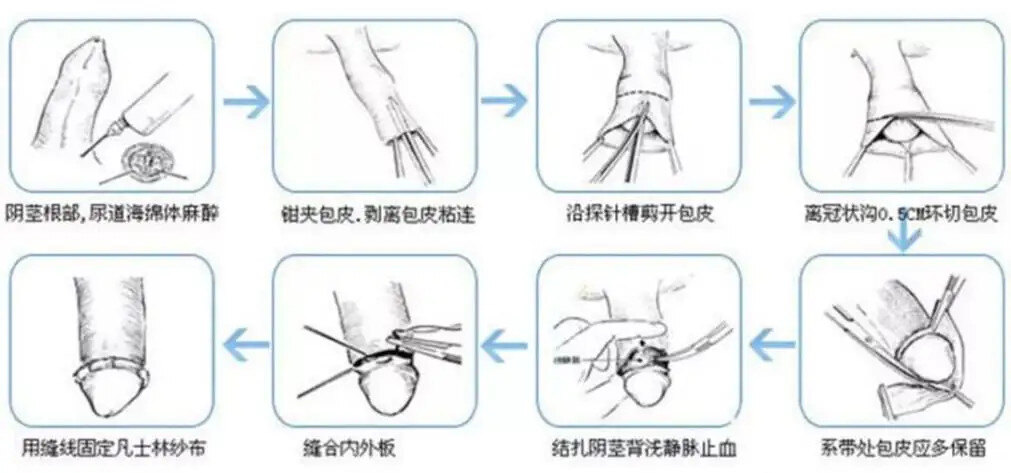 剪刀式包皮环切术查阅国内外正规手术学,包皮环切术只有四种方法
