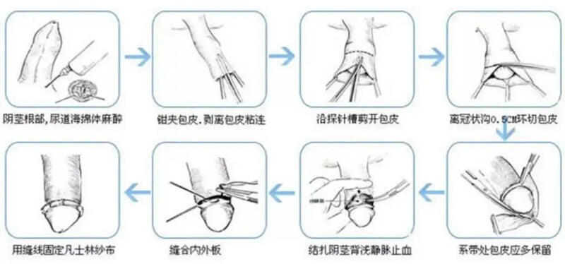 姜華龍醫生的科普號2022年03月29日136003說說包皮環切包皮環切手術是