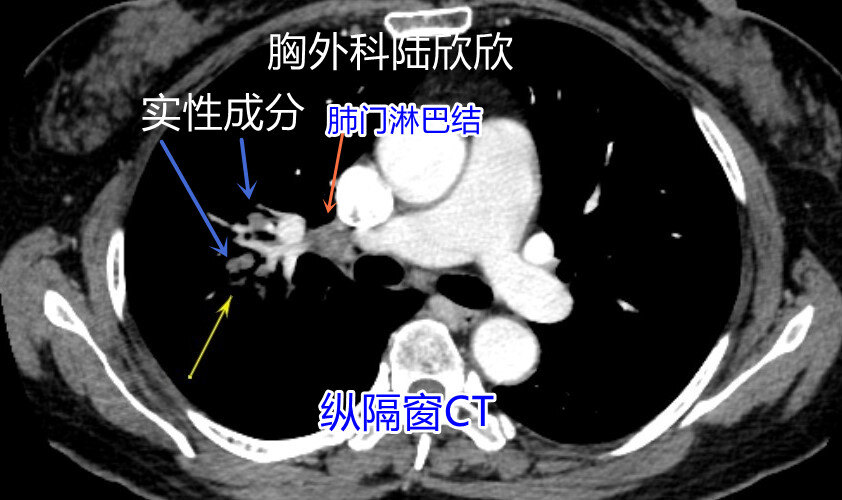 扭曲僵硬支气管纵隔窗水印.jpg