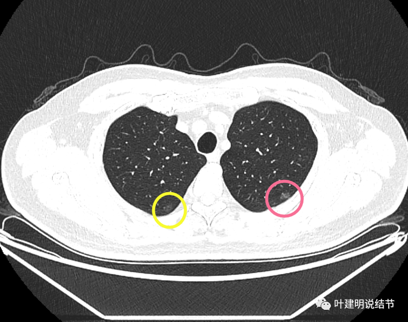 輪廓清病灶1-3:右上葉純磨玻璃結節,瘤肺邊界清,密度低,沒有明顯分葉