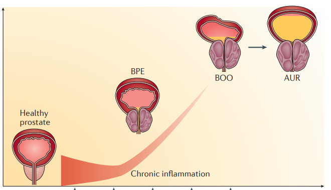 认识良性前列腺增生_前列腺增生_介绍_发病原因_症状表现_检查_治疗