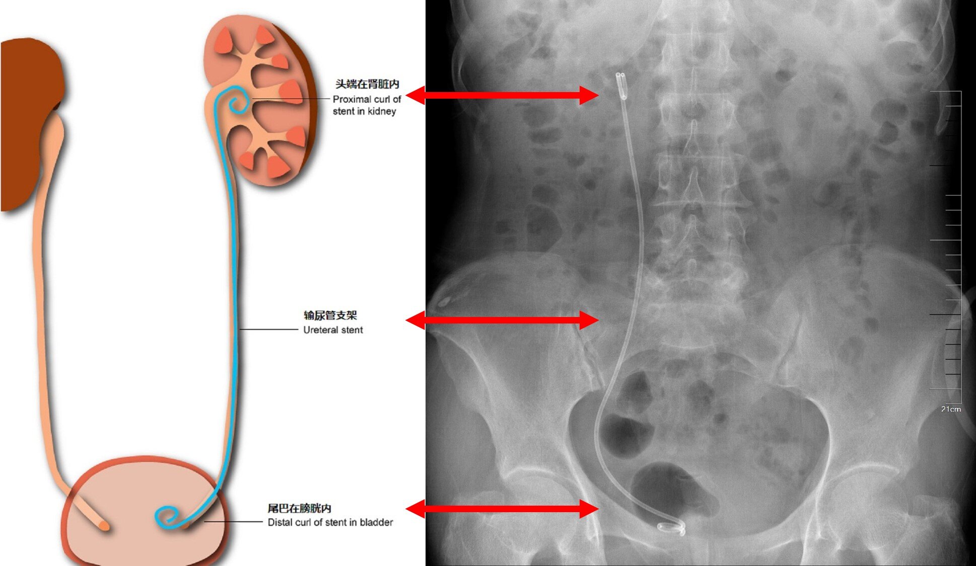 输尿管支架放置须知