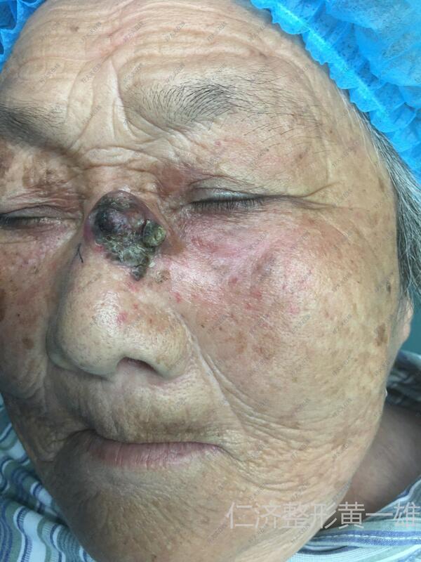 脸上恶性肿瘤早期图片图片