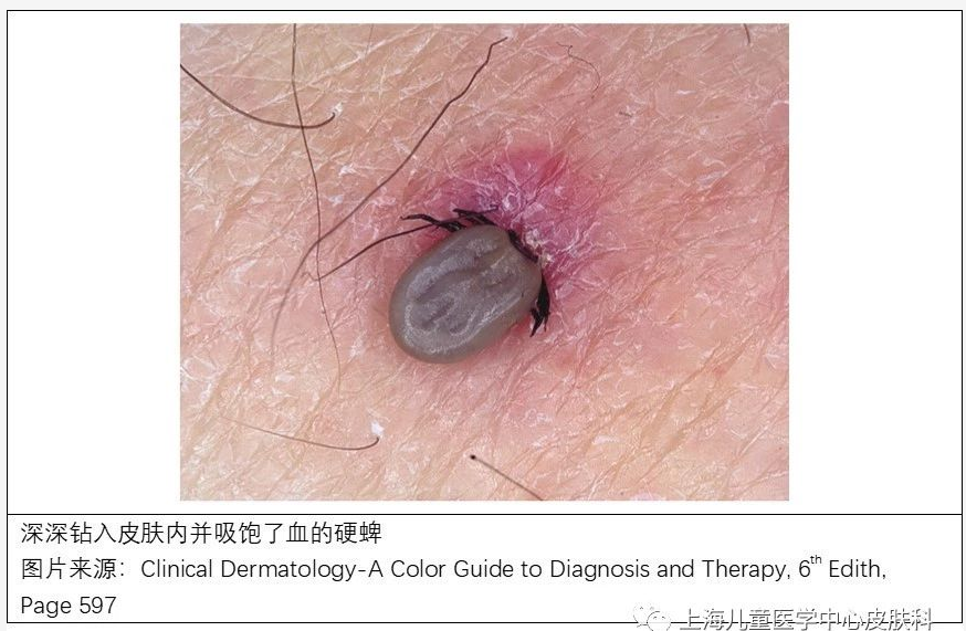 蜱叮咬不要恐慌_虫媒传染病_虫媒传染病预防 - 好大夫在线