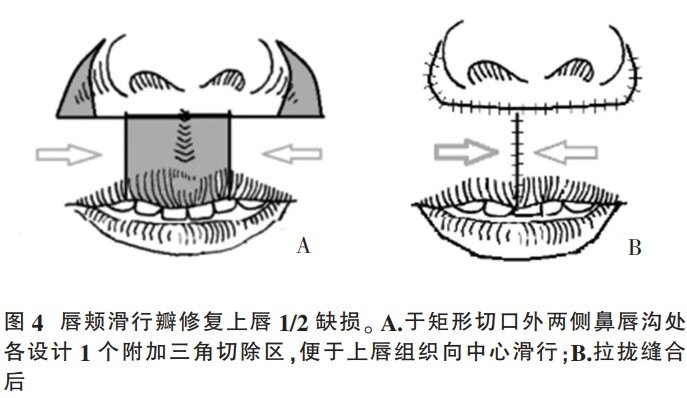 唇癌的手术治疗和修复方式_唇癌_唇癌治疗方式 - 好大夫在线