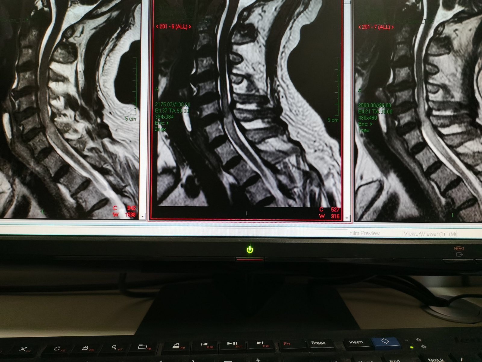脊髓型颈椎病应及时手术治疗 脊髓型颈椎病 脊髓型颈椎病治疗方式 好大夫在线