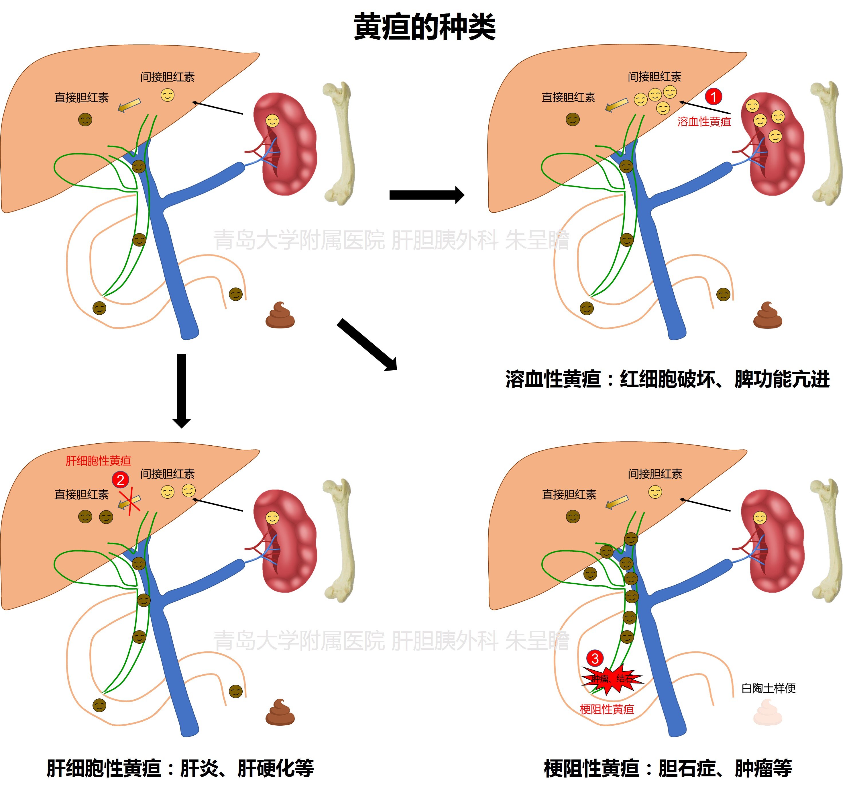 成人全身皮肤、巩膜黄染(黄疸的种类)_黄疸_介绍_症状表现 - 好大夫在线