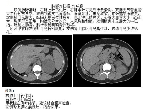 复杂性肾囊肿伴分隔钙化