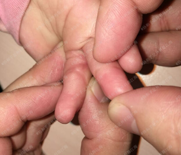 并指宝宝进行分指手术,最佳治疗时间是什么时候?是否需要植皮?