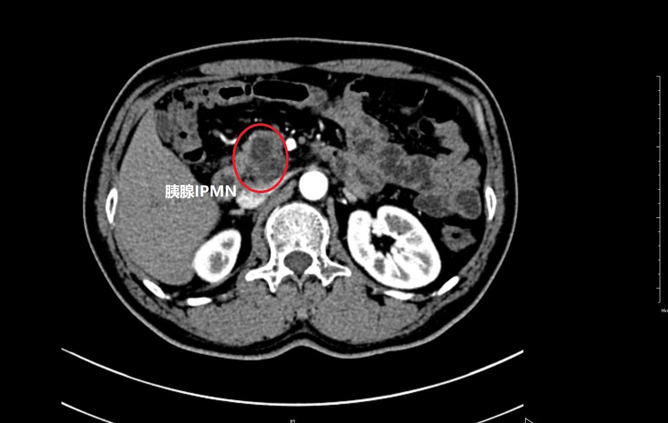 胰管型ipmn图片