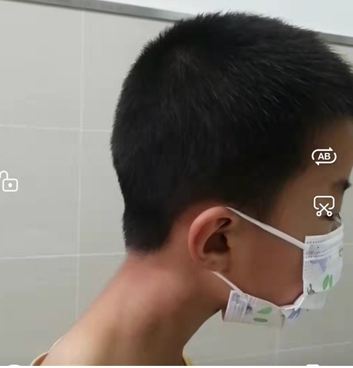 Sandifer Position Sandifer综合征(Sandifersyndrome)_胃食管反流病 - 好大夫在线