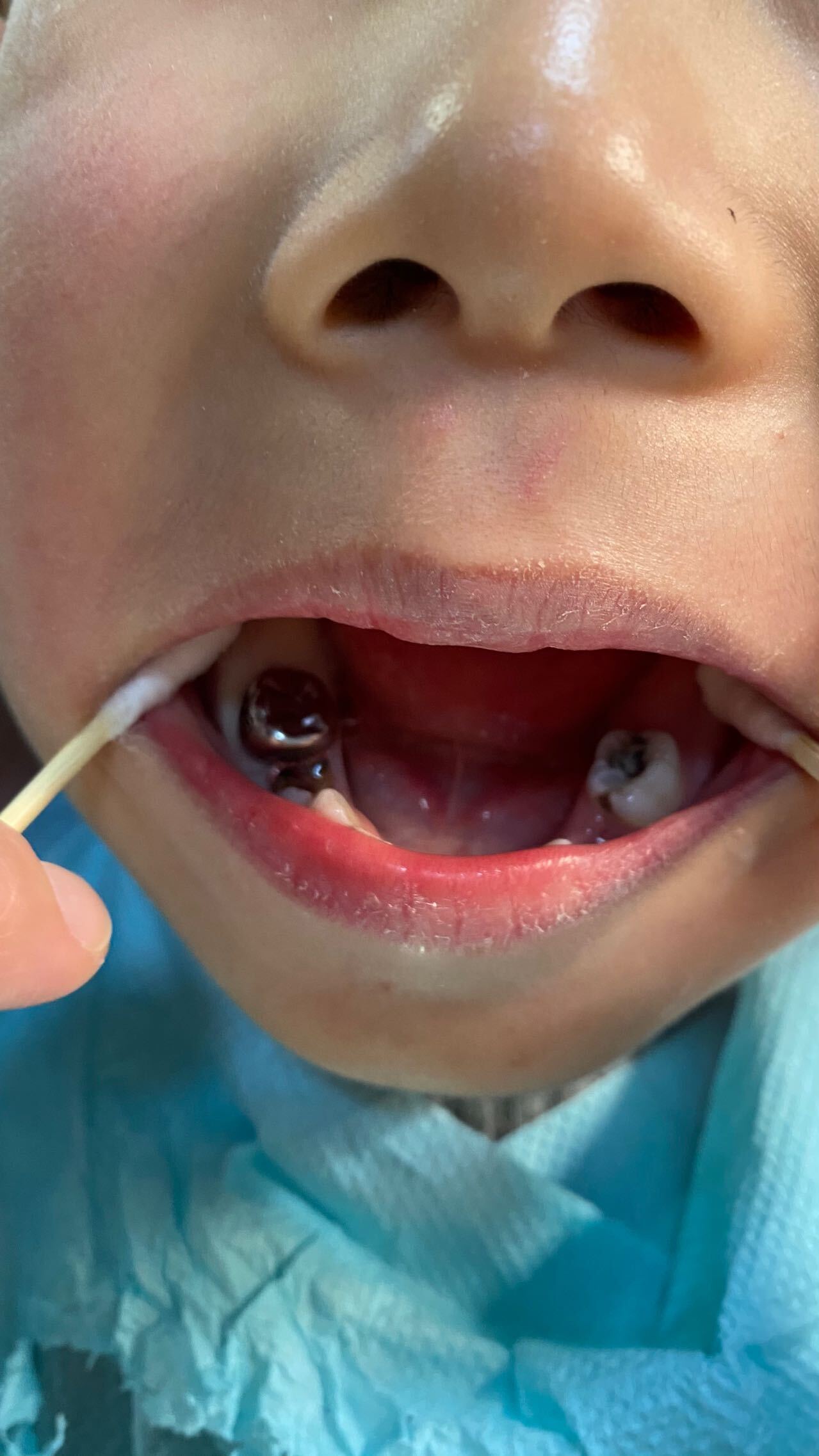 乳牙预成冠会影响正常替换牙吗？_口腔修复_口腔修复治疗介绍 - 好大夫在线
