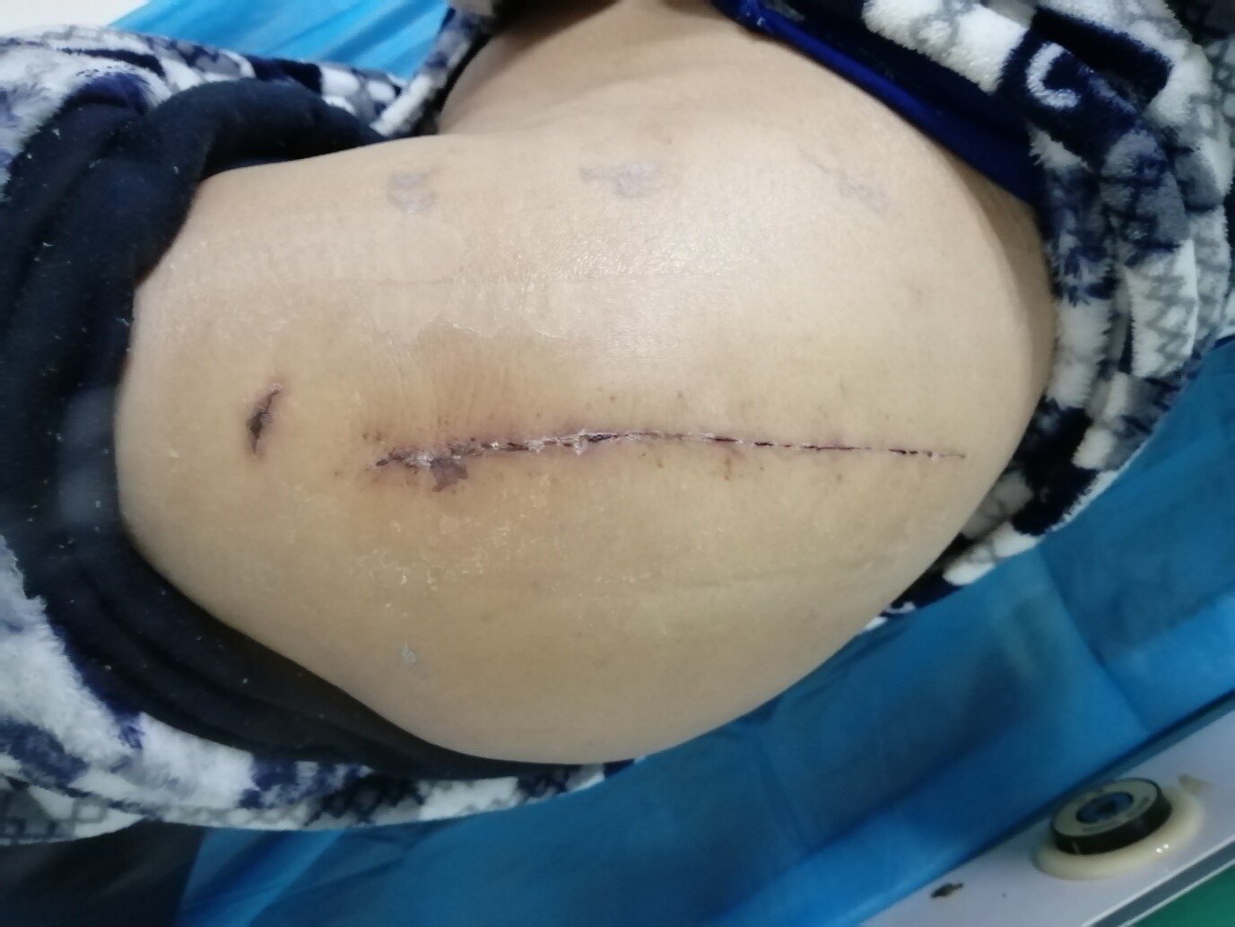 与使用被动敷料处理的伤口相比,使用薄膜敷料(优势比,0.