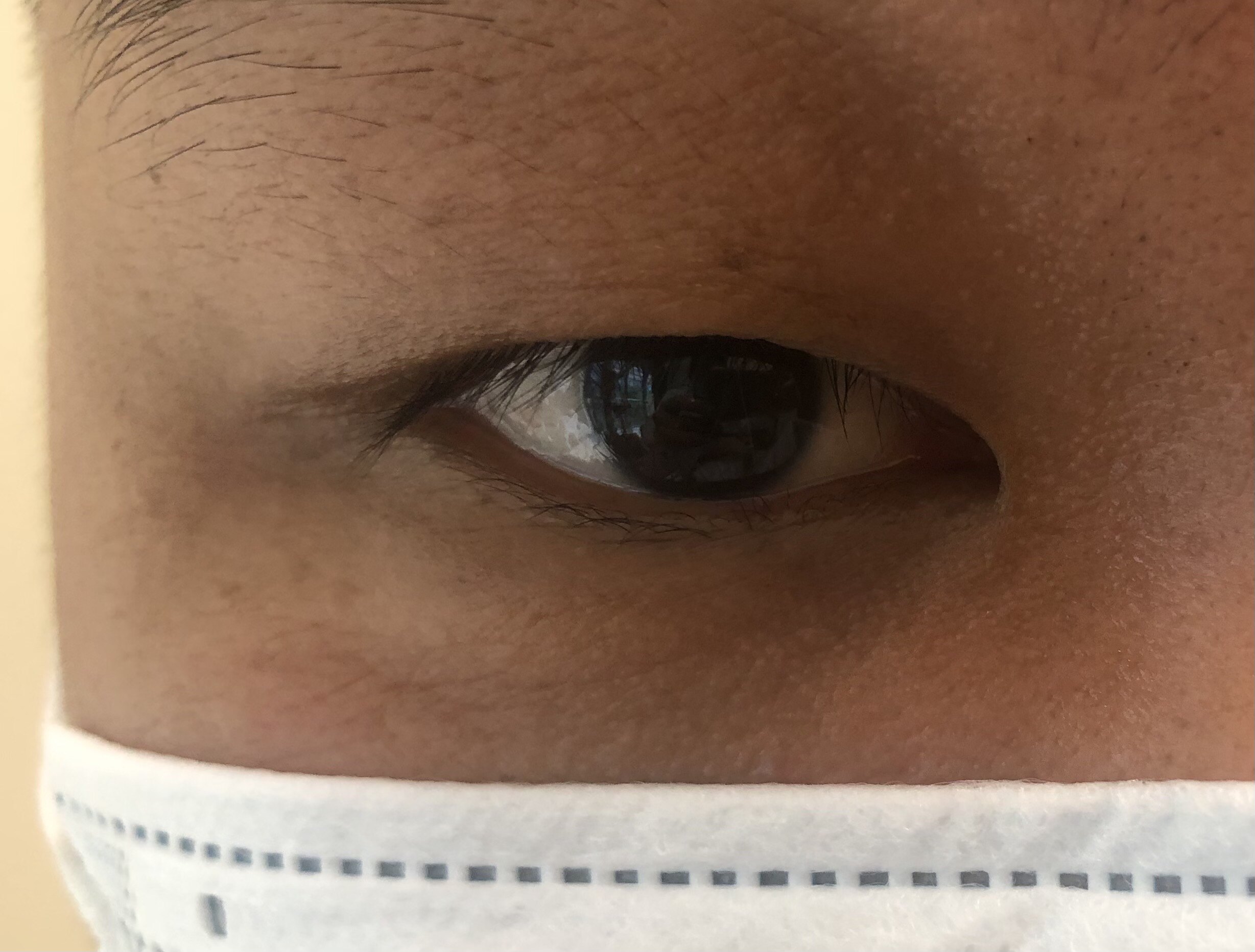 『新技术 开新局』呼和浩特市第一医院眼科新技术分享——眼睑肿物切除+睑板移植+眼睑缺损全层重建术一例-呼和浩特市第一医院