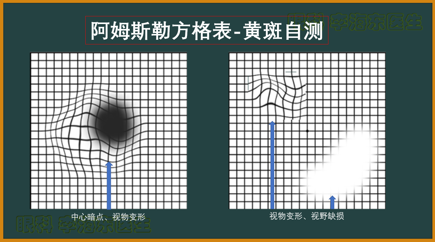 黄斑自测图图片