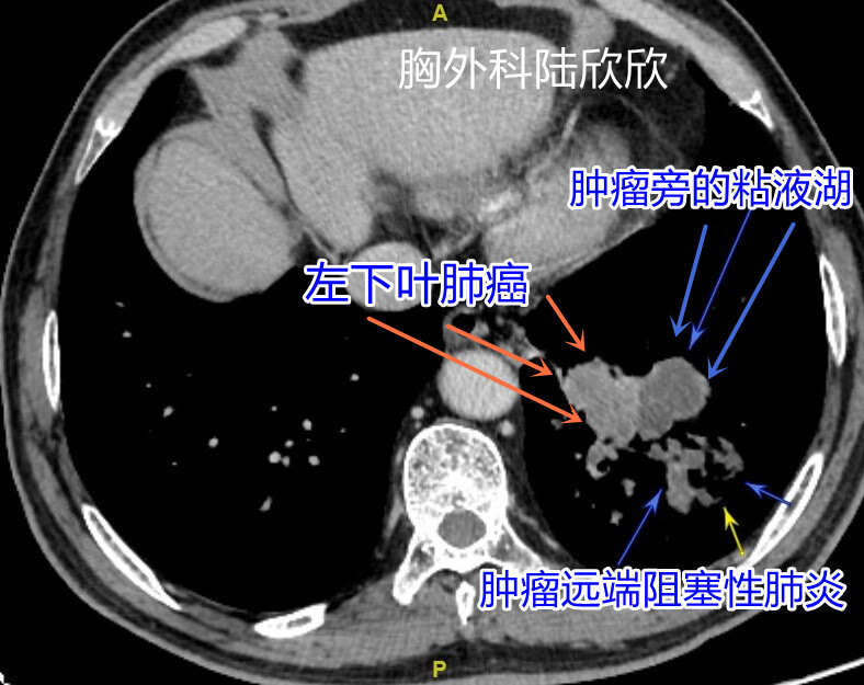 远端炎症水印.jpg