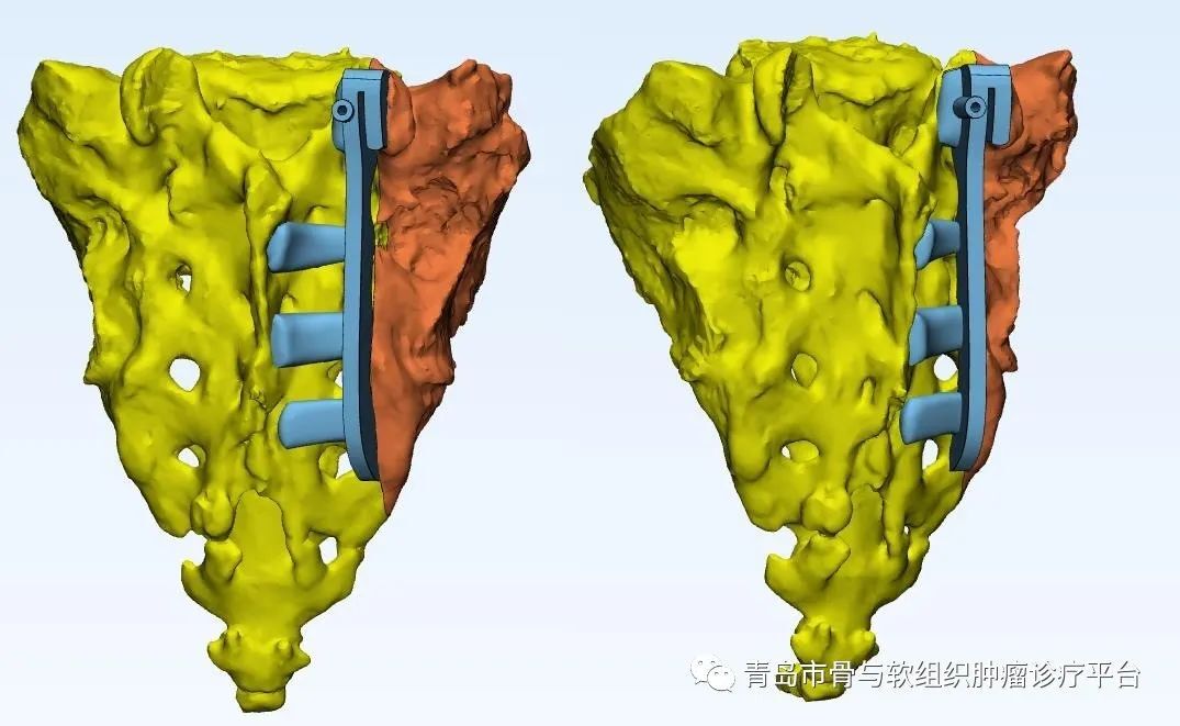 【典型病例】腎癌骨盆轉移 右側i ii iv區腫瘤切除 3d打印半骨盆假體