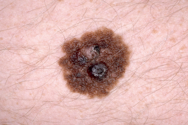 C0494515-Malignant_melanoma.jpg