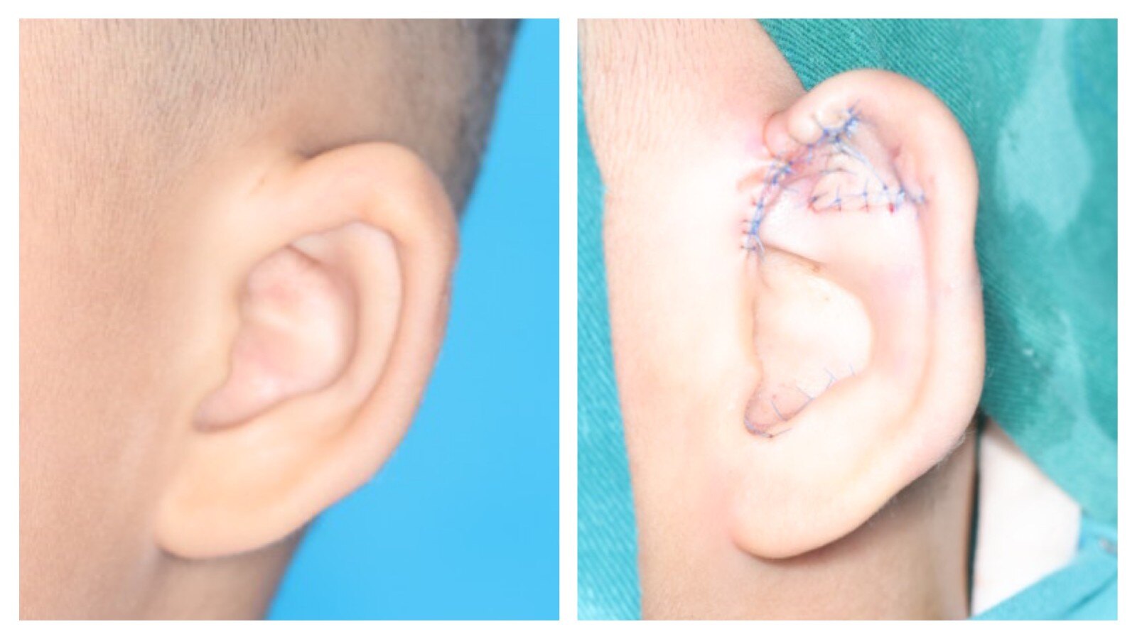 【案例分析】男子嫌右侧杯状耳不好看，做手术矫正_耳轮_形态_耳廓