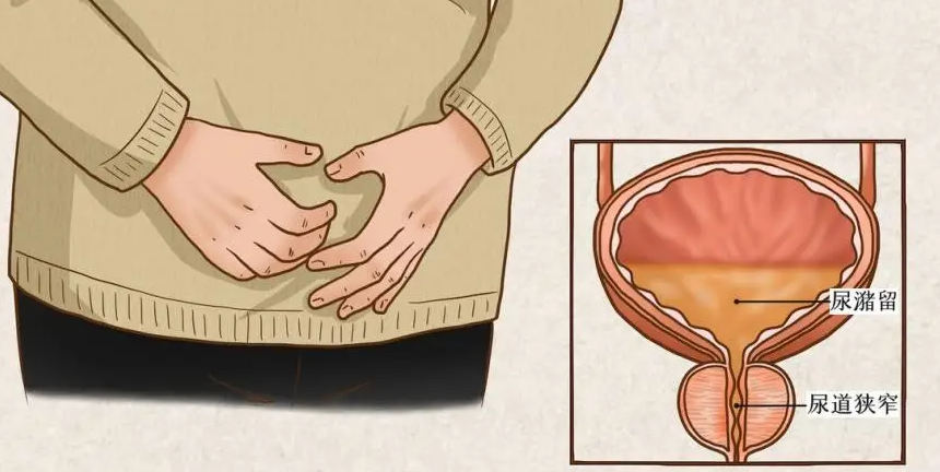 尿潴留是什么意思到底是什么原因导致的