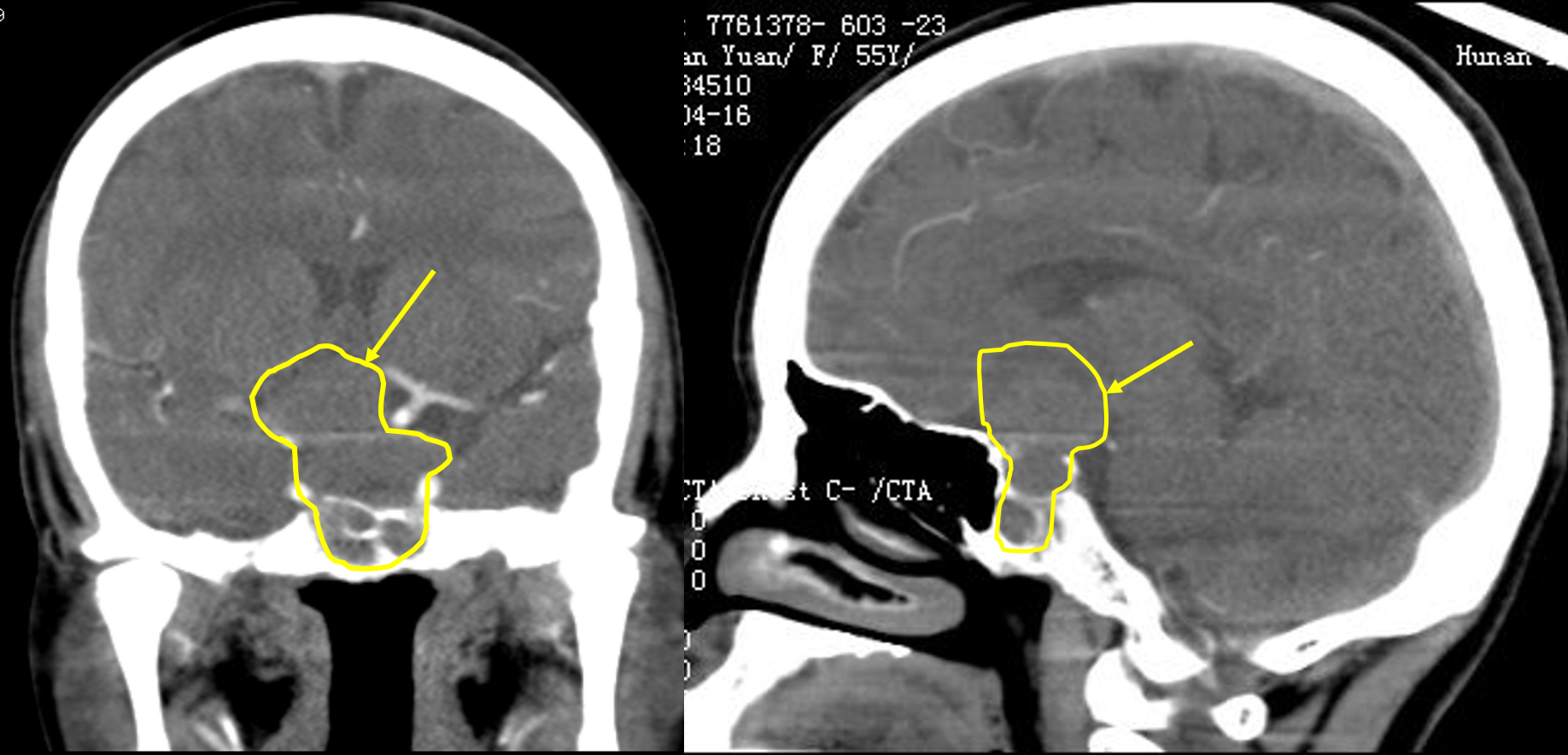 垂体ct在头部位置图片图片