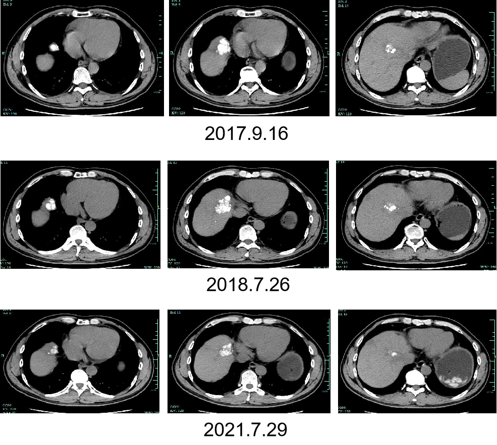 肝癌晚期ct图片图片
