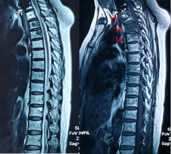 脊柱转移瘤如何治疗