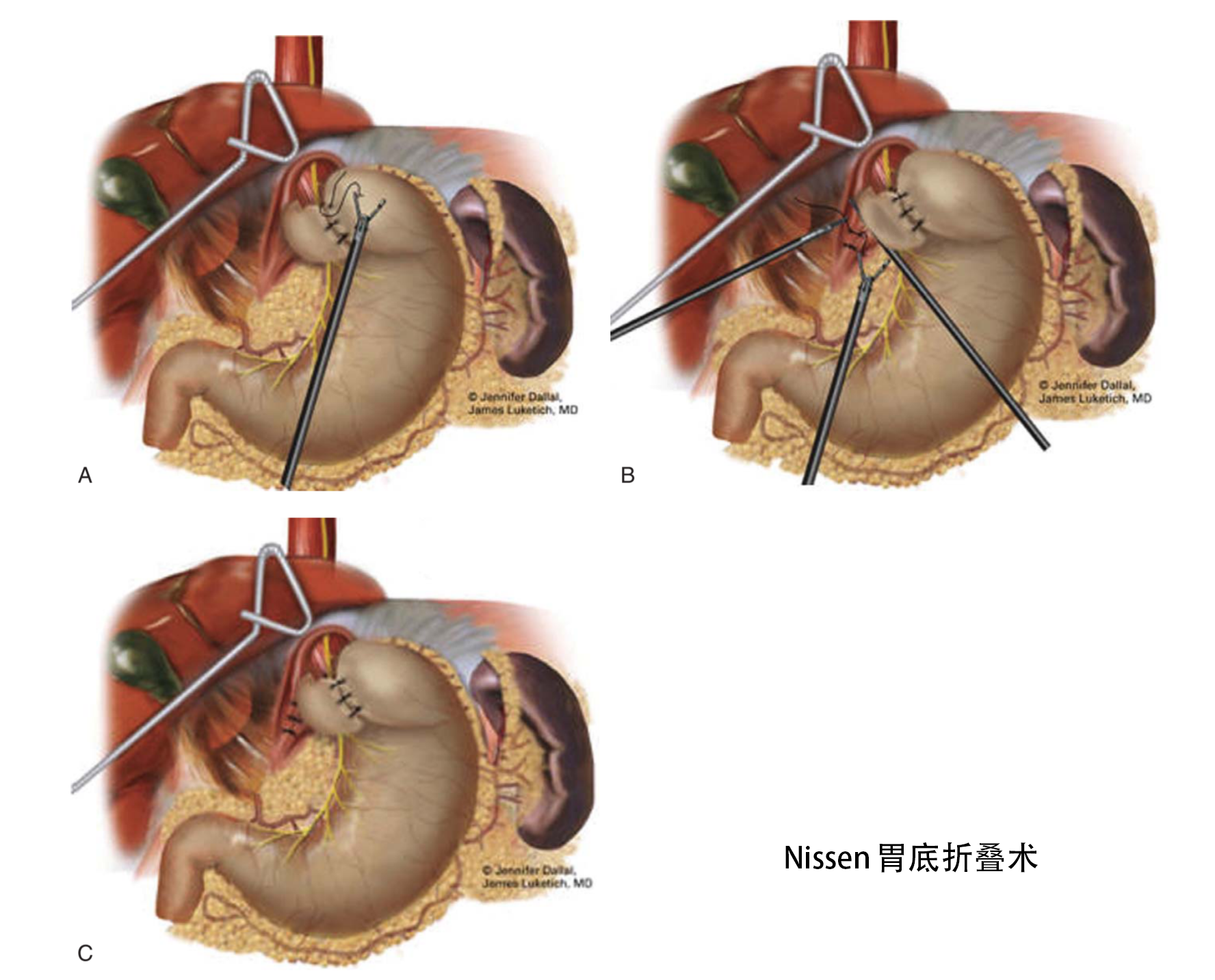 3, dors胃底折叠术将胃底180°包绕食管前壁,为部分胃底折叠术.