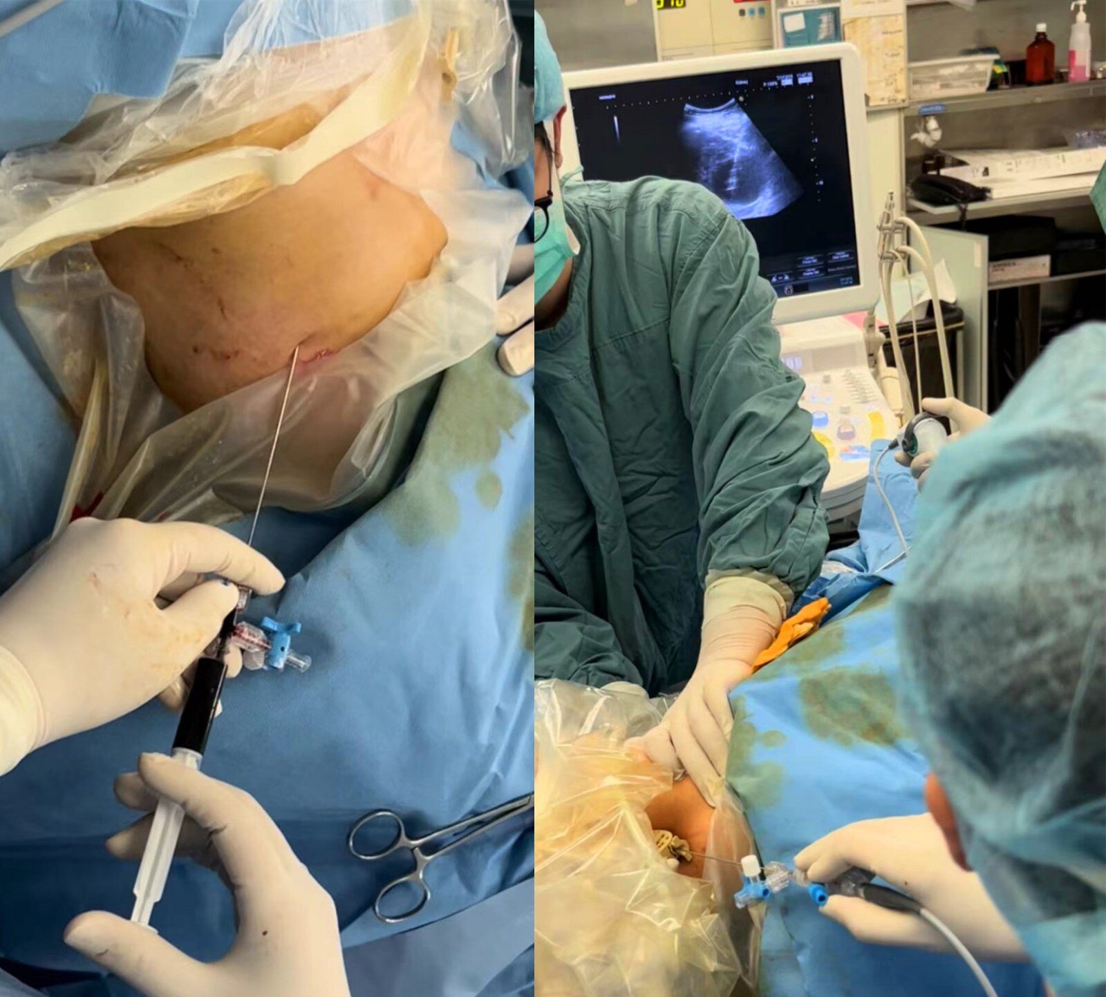 斜仰截石位腰部也要压垫显露腰部空间利于双镜联合,这种体位碎石后