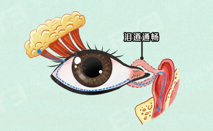 总是莫名流泪,竟是泪道在 “求救”_泪道阻塞_症状表现_治疗方式 - 好大夫在线