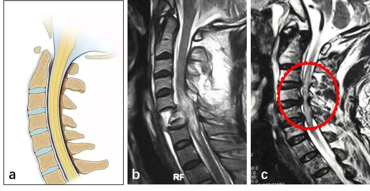 人体的颈椎一共有7节,椎管内走行着颈脊髓(图1a),颈脊髓承接大脑并