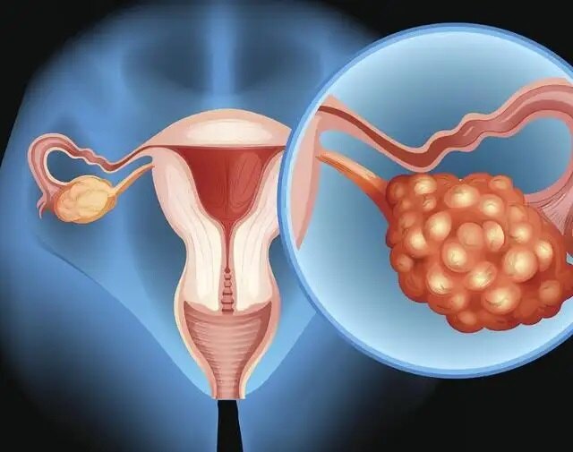 卵巢癌中期图片
