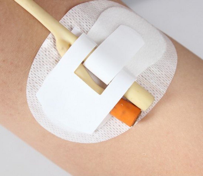 留置导尿管后,患者应该注意哪些?