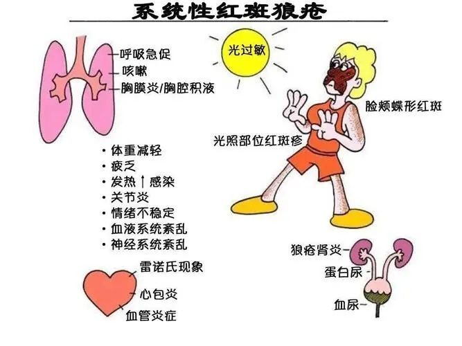 自身免疫性疾病与复发性流产